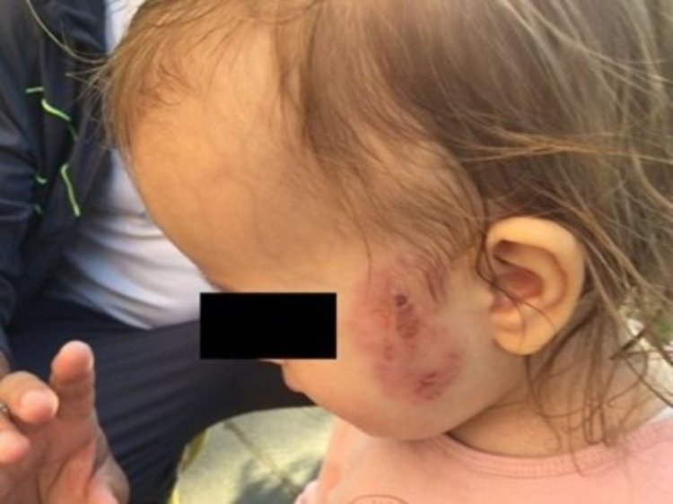 Ще има уволнения, след като дете нахапа зверски друго в ясла