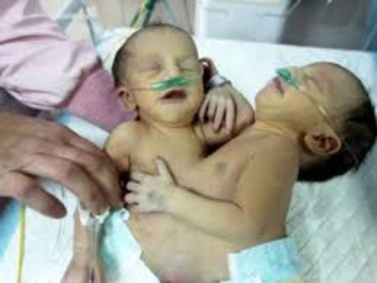 14-годишна роди сиамски близнаци, с общ таз са  