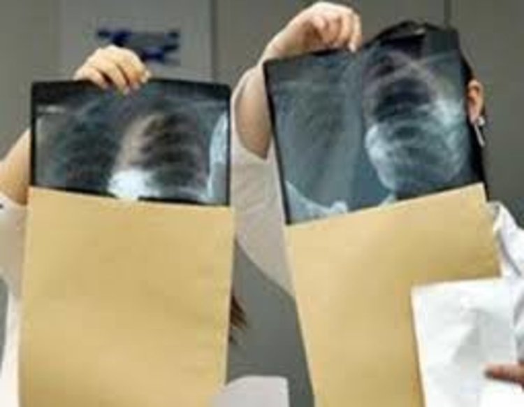 Безплатни прегледи за туберкулоза, седмица на отворените врати в кърджалийската болница