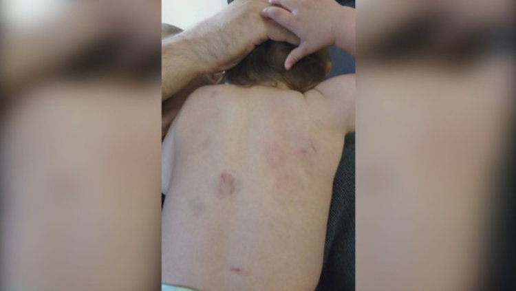 Отстраниха директорката и две медицински сестри от градината, където нахапаха дете  