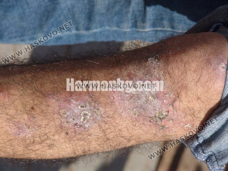 Тропически зарази вилнеят в лагера в Харманли, 41 с краста