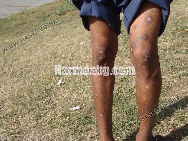 Тропически зарази вилнеят в лагера в Харманли, 41 с краста