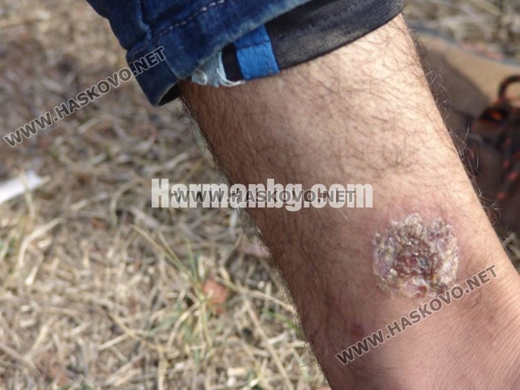 Тропически зарази вилнеят в лагера в Харманли, 41 с краста