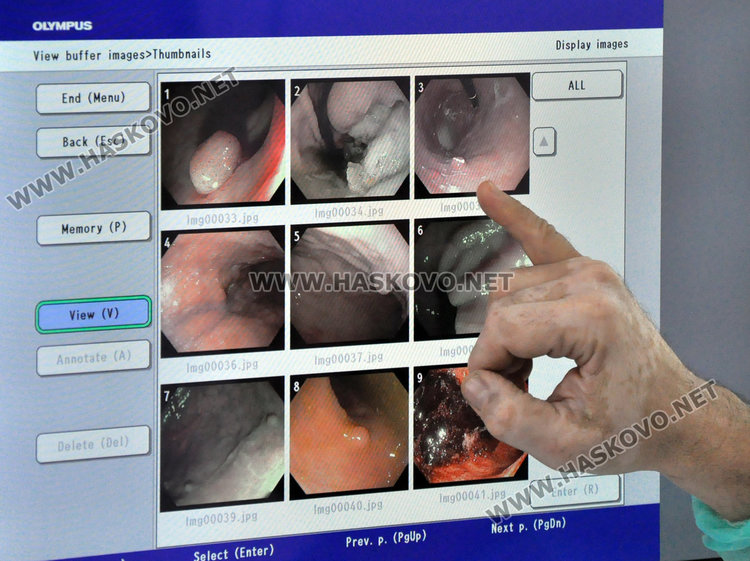 Най-добрият в света ендоскоп за ранна диагностика на рак работи в МБАЛ