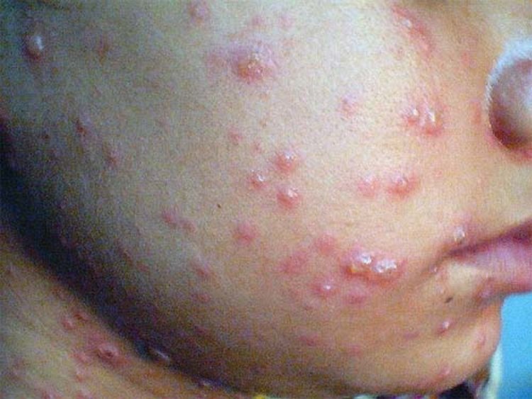 Един случай на скарлатина и 16 на едра шарка за изминалата седмица в Кърджали