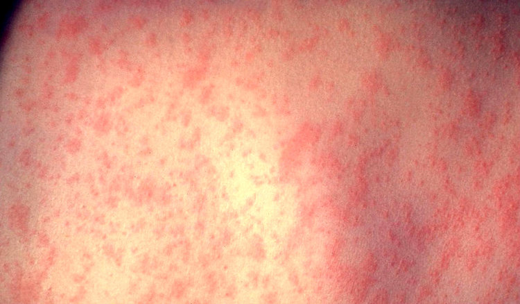 Затвориха детско отделение в Пловдив заради морбили