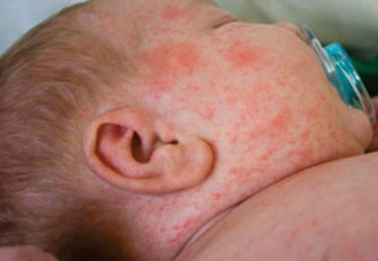 РЗИ: ваксинирайте децата срещу морбили, те са най-уязвими