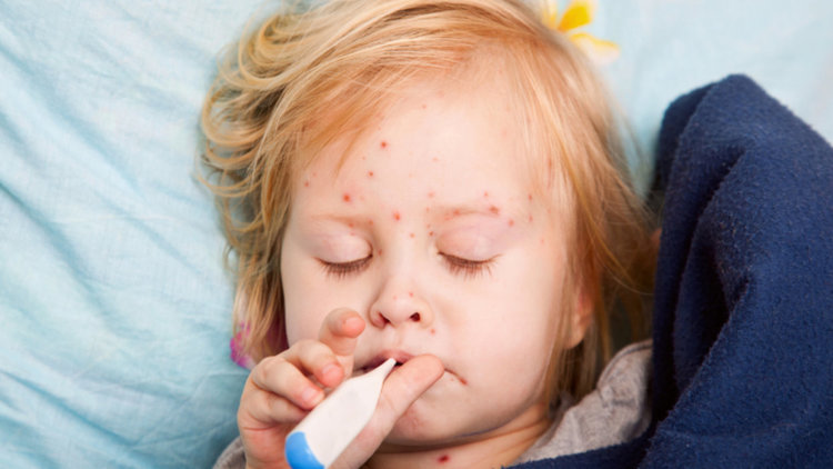 Вътреболнична инфекция от морбили в пловдивска болница