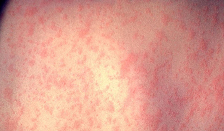 Само за ден: Нови 4 случая на морбили в Пловдивско