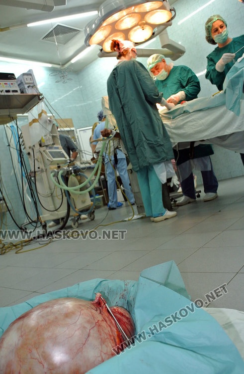 Извадиха 12-килограмов тумор от корема на 72-годишна