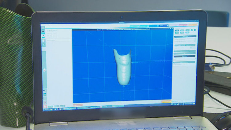 Момче, загубило крака си, създава програма за 3-D протези