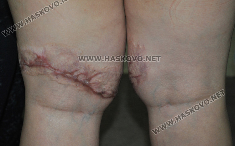 Изгарянията на малкия Мерт 7 месеца след инцидента