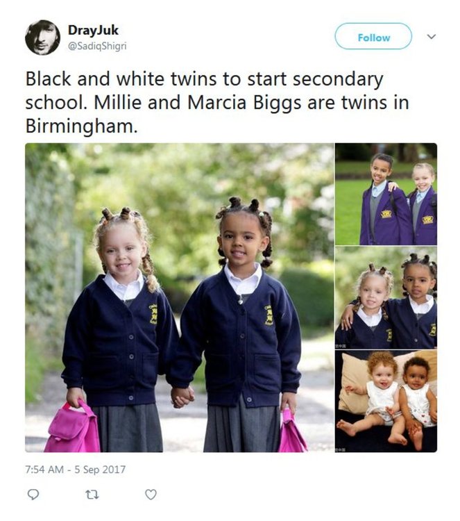 Близначки с различен цвят на кожата се превърнаха в истинска сензация