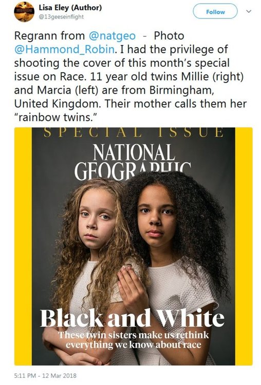 Близначки с различен цвят на кожата се превърнаха в истинска сензация