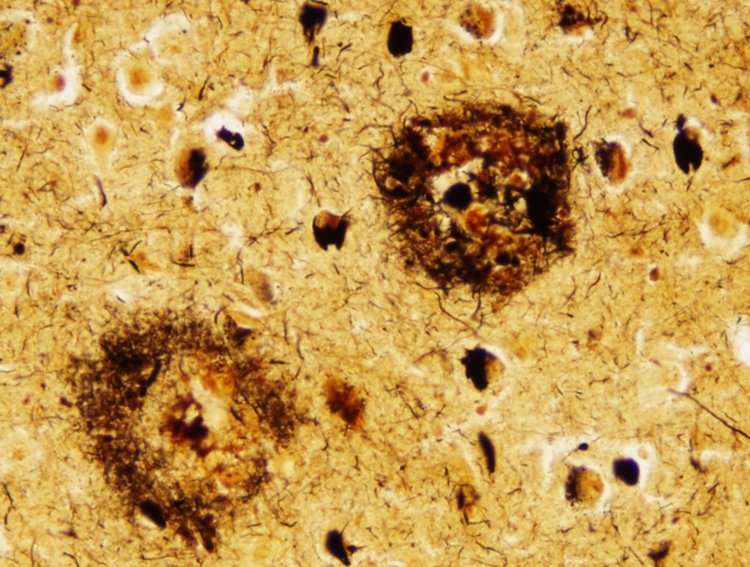 Амилоибните плаки, които са характерна картина за Алцхаймер