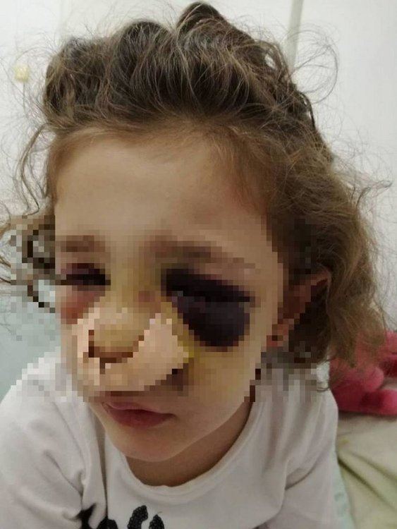 4-годишно дете пострада сериозно след тежък инцидент в детска градина 