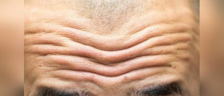 Бръчките по челото показват здравето на сърцето ви