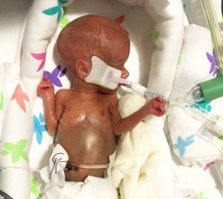 Бебче, родено 340 грама, оцеля!