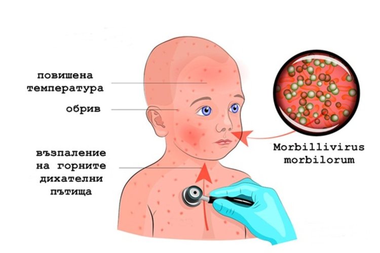 РЗИ: Морбили в Смолян и областта няма, последно епидемия е имало през 2010г