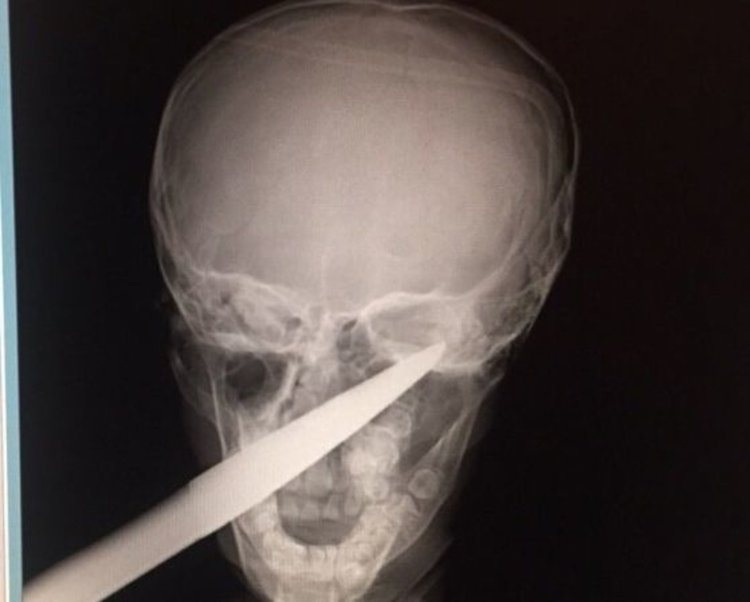 Спасиха дете със забита в главата градинска ножица