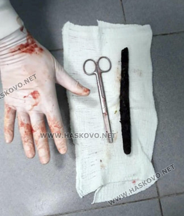 Хирурзи откриха рядко образувание в корема на хасковлия (видео) 