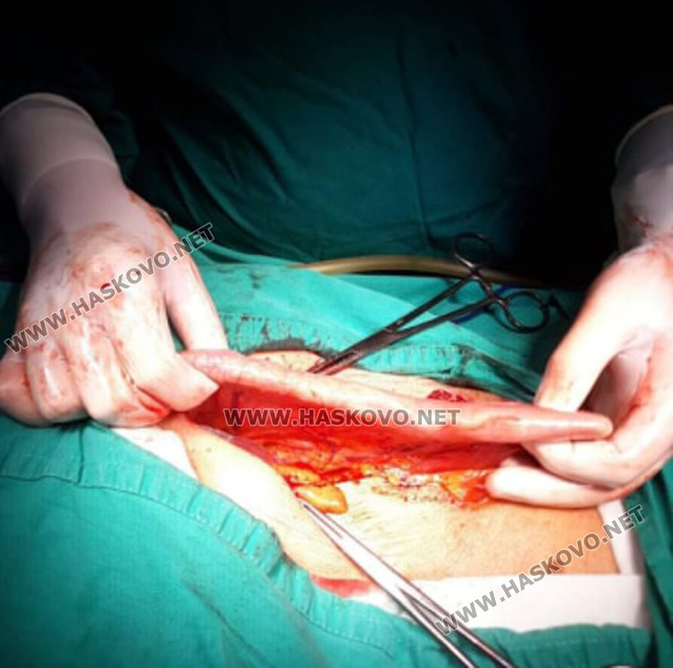 Хирурзи откриха рядко образувание в корема на хасковлия (видео) 