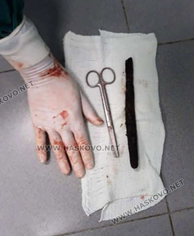 Хирурзи откриха рядко образувание в корема на хасковлия (видео) 