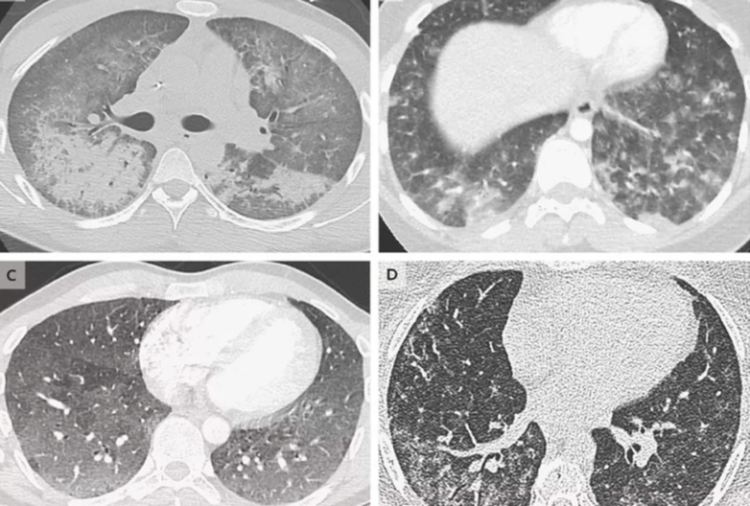 Трима души са умрели при мистериозни обстоятелства, след употребата на електронни цигари