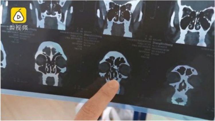 Извадиха зъб от носа на китаец