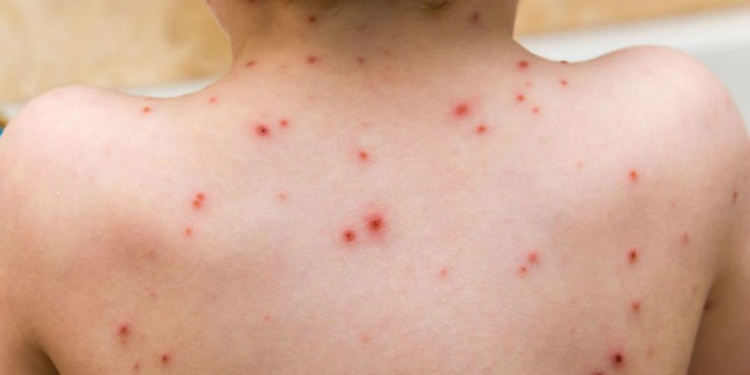 27 потвърдени случая на морбили в Пернишко от началото на годината