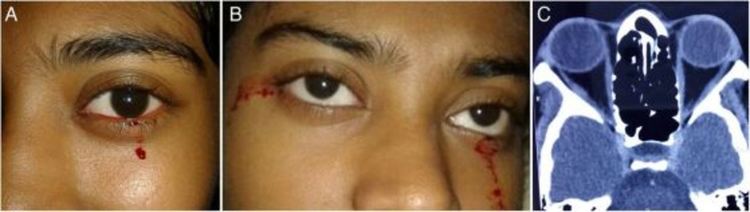 Медицински феномен - момиче плаче с кървави сълзи, но лекарите не знаят защо