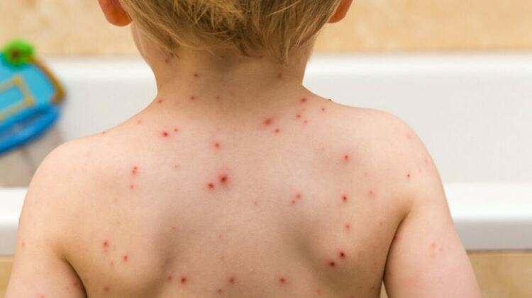 Варицелата не отстъпва в Кърджалийско въпреки горещините, за седмица 13 нови случая