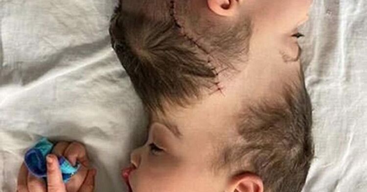 Сиамски близнаци бяха успешно разделени с 27-часова операция