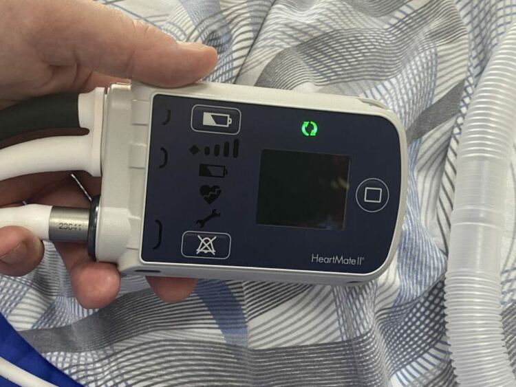 В болница ''Чирков'' имплантираха изкуствено сърце на млад мъж