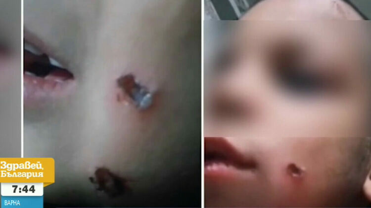 Баща от Кърджали се хвали в социалните мрежи със снимки на горено с фасове дете, води се разследване