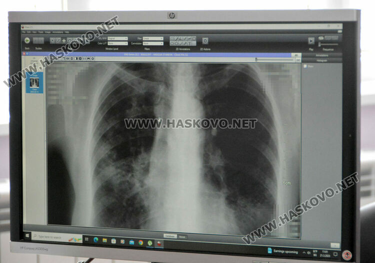 9 души с туберкулоза са регистрирани в Хасково през 2023 г. 