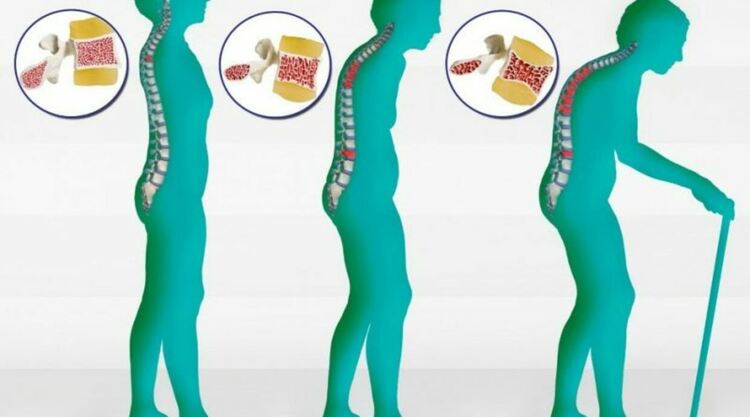 Д-р Иван Томов: Регулярните изследвания за остеопороза намаляват риска от тежки последствия