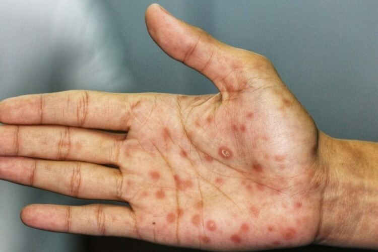 Случай на сифилис откриха в Кърджалийско,напомня за ендемичните огнища оставени още от кръстоносците 