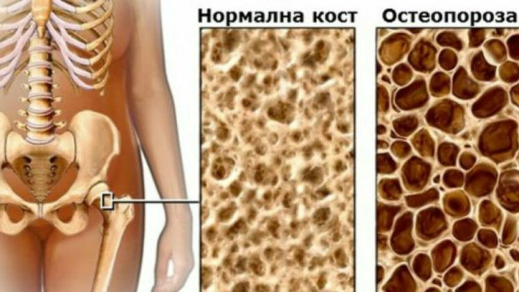 Профилактични прегледи за остеопороза и измерване на костна плътност ще се извършват в бившата общинска болница в Брезник