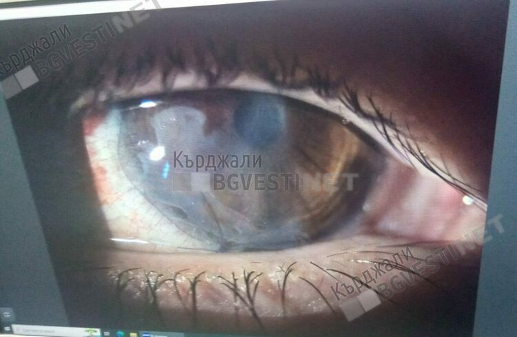 Зов за помощ:Млада кърджалийка губи зрението си,само спешна операция може да я спаси,помогнете!