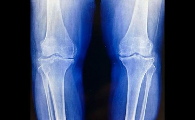 Остеоартритът е нелечимо заболяване, при което хрущялната възглавница вътре в ставата се разрушава.