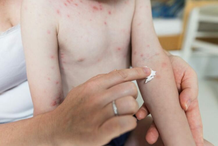 Ваксината срещу варицела задължителна догодина, безплатна и за родените през 2025 г.