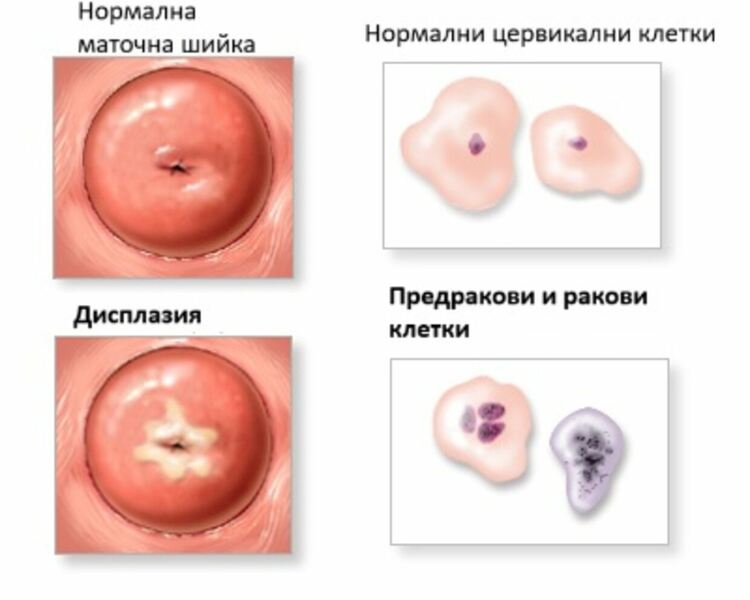 Пловдивският онкогинеколог д-р Андреев – ранната диагноза и лечение на предраковите изменения на маточната шийка спасява живота на пациентките