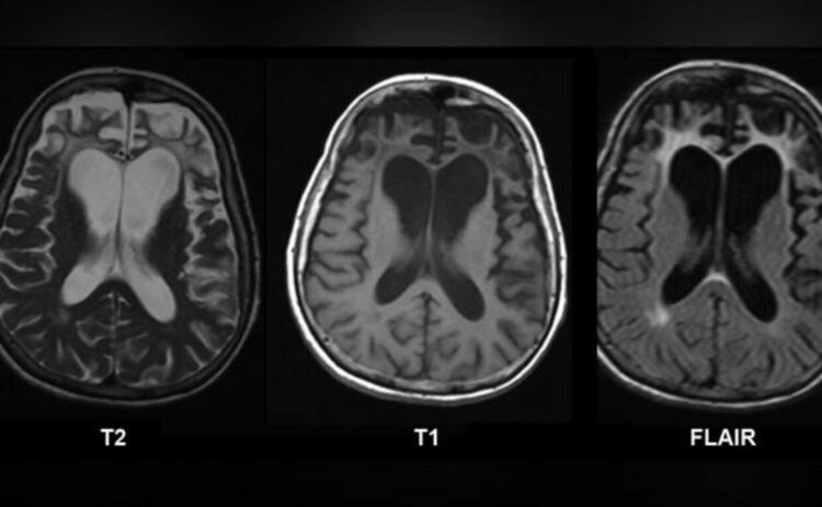 ЯМР на мозъка на пациент с болестта на Пик ili фронтотемпорална деменция (FTD). Атрофияta на кората и бялото вещество на фронталните лобове е ясно видима. Ядрено-магнитният резонанс е извършен без контрастно усилване с помощта на скенер.