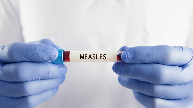 Расте броят на болните от морбили в страната