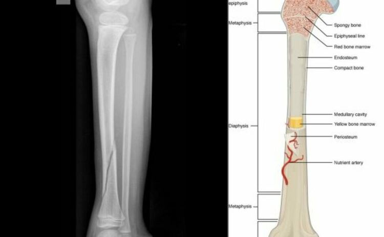 Вляво: снимка на костна фрактура, вдясно: анатомия на тибия